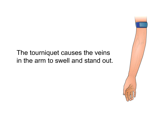 The tourniquet causes the veins in the arm to swell and stand out.