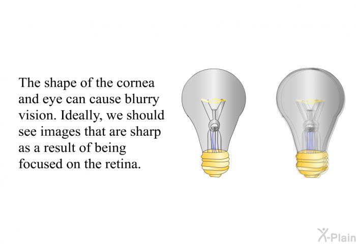 The shape of the cornea and eye can cause blurry vision. Ideally, we should see images that are sharp as a result of being focused on the retina.