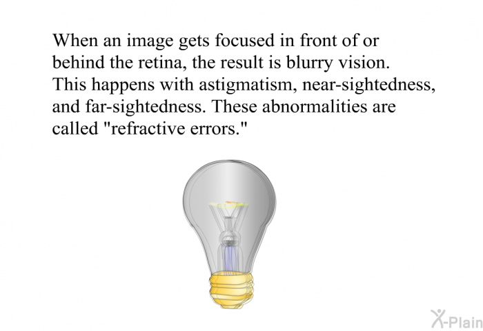 When an image gets focused in front of or behind the retina, the result is blurry vision. This happens with astigmatism, near-sightedness, and far-sightedness. These abnormalities are called "refractive errors."