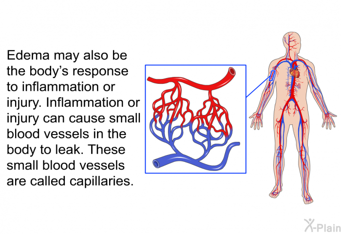 Edema may also be the body's response to inflammation or injury. Inflammation or injury can cause small blood vessels in the body to leak. These small blood vessels are called capillaries.