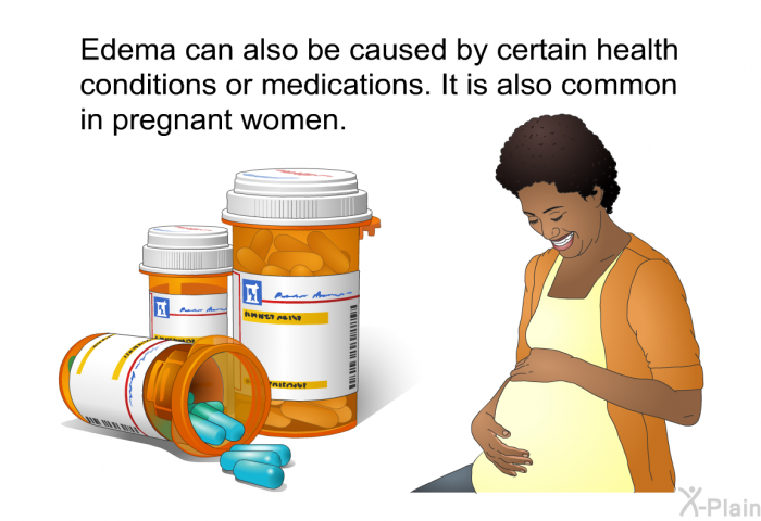 Edema can also be caused by certain health conditions or medications. It is also common in pregnant women.
