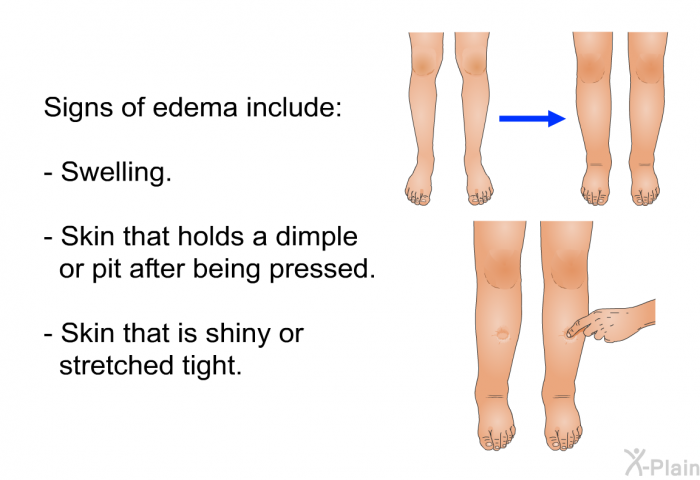 Signs of edema include:  Swelling. Skin that holds a dimple or pit after being pressed. Skin that is shiny or stretched tight.