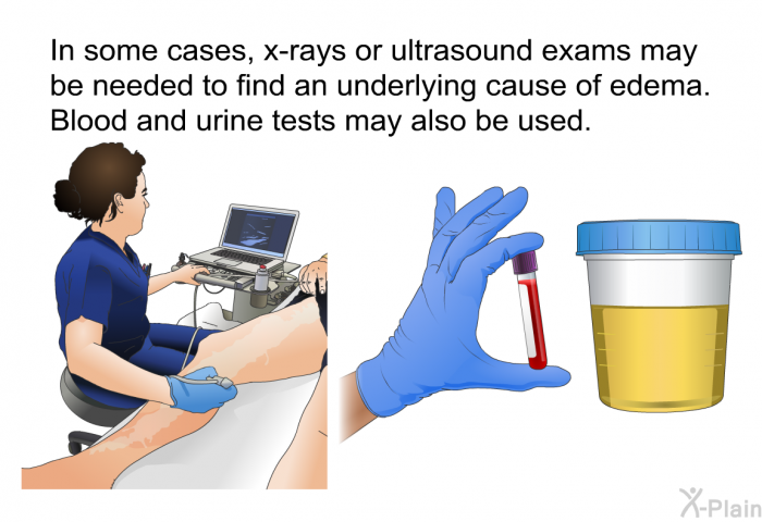 In some cases, x-rays or ultrasound exams may be needed to find an underlying cause of edema. Blood and urine tests may also be used.