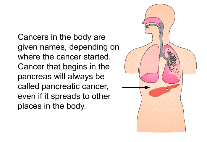 Cancers in the body are given names, depending on where the cancer started. Cancer that begins in the pancreas will always be called pancreatic cancer, even if it spreads to other places in the body.