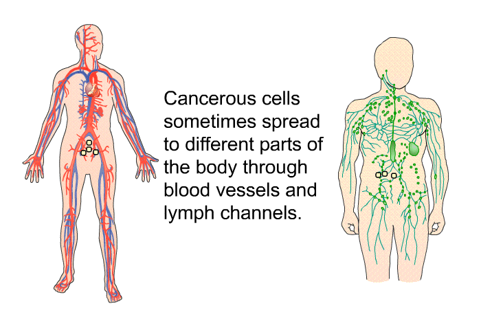Cancerous cells sometimes spread to different parts of the body through blood vessels and lymph channels.