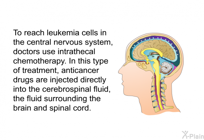 To reach leukemia cells in the central nervous system, doctors use intrathecal chemotherapy. In this type of treatment, anticancer drugs are injected directly into the cerebrospinal fluid, the fluid surrounding the brain and spinal cord.