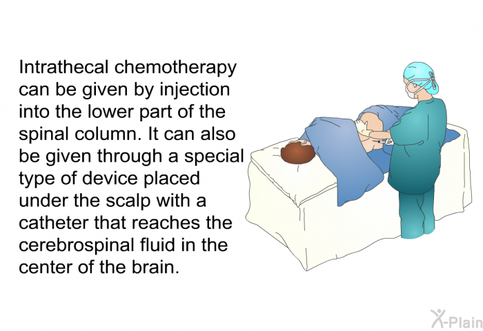 Intrathecal chemotherapy can be given by injection into the lower part of the spinal column. It can also be given through a special type of device placed under the scalp with a catheter that reaches the cerebrospinal fluid in the center of the brain.