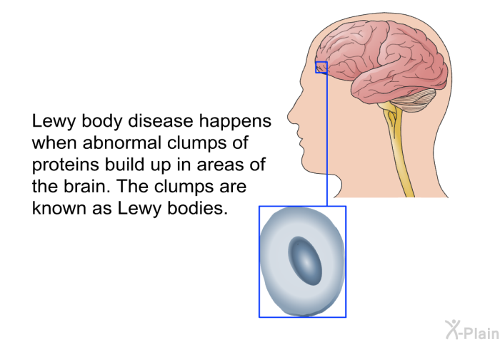 Lewy body disease happens when abnormal clumps of proteins build up in areas of the brain. The clumps are known as Lewy bodies.