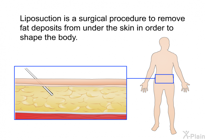 Liposuction is a surgical procedure to remove fat deposits from under the skin in order to shape the body.