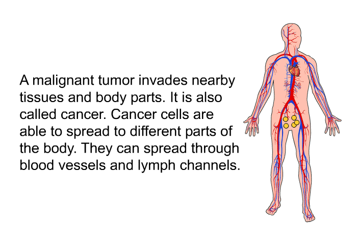 A malignant tumor invades nearby tissues and body parts. It is also called cancer. Cancer cells are able to spread to different parts of the body. They can spread through blood vessels and lymph channels.