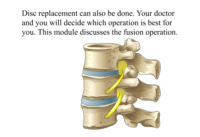 Disc replacement can also be done. Your doctor and you will decide which operation is best for you. This module discusses the fusion operation.