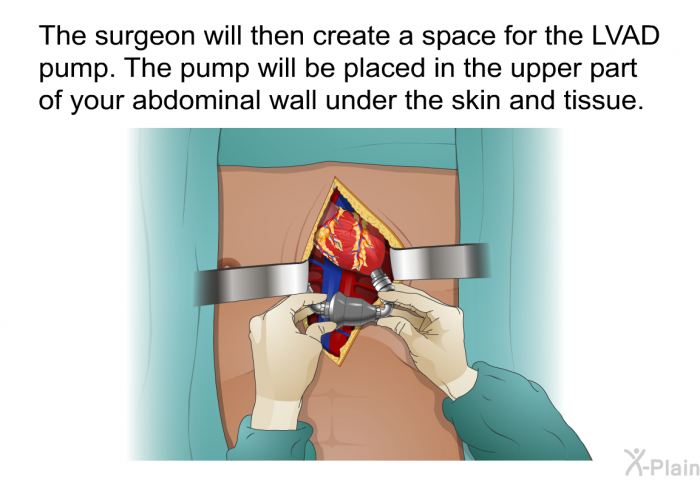 The surgeon will then create a space for the LVAD pump. The pump will be placed in the upper part of your abdominal wall under the skin and tissue.