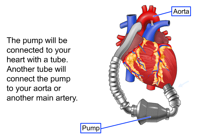 The pump will be connected to your heart with a tube. Another tube will connect the pump to your aorta or another main artery.