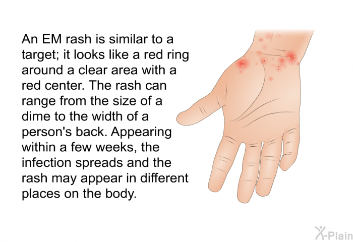 An EM rash is similar to a target; it looks like a red ring around a clear area with a red center. The rash can range from the size of a dime to the width of a person's back. Appearing within a few weeks, the infection spreads and the rash may appear in different places on the body.