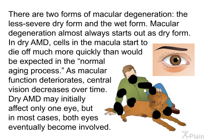 There are two forms of macular degeneration: the less-severe dry form and the wet form. Macular degeneration almost always starts out as dry form. In dry AMD, cells in the macula start to die off much more quickly than would be expected in the “normal aging process.” As macular function deteriorates, central vision decreases over time. Dry AMD may initially affect only one eye, but in most cases, both eyes eventually become involved.