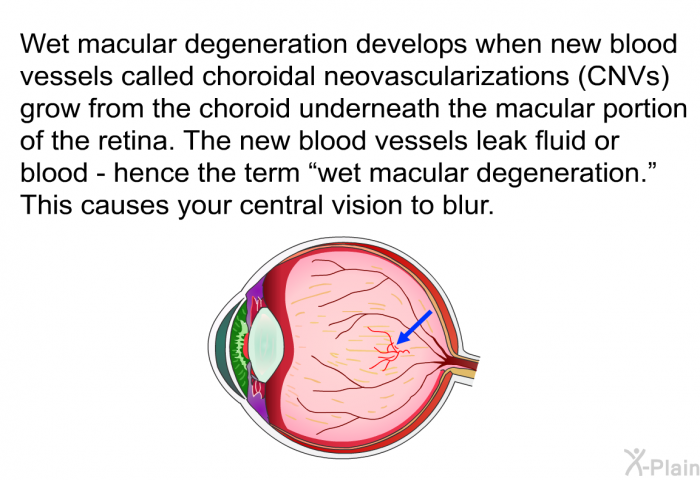 Wet macular degeneration develops when new blood vessels called choroidal neovascularizations (CNVs) grow from the choroid underneath the macular portion of the retina. The new blood vessels leak fluid or blood – hence the term “wet macular degeneration.” This causes your central vision to blur.