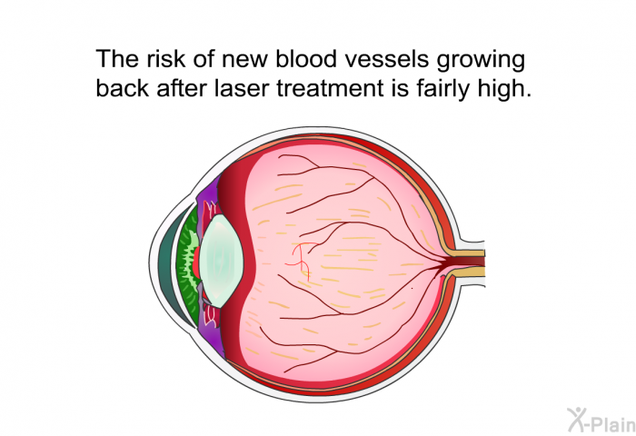 The risk of new blood vessels growing back after laser treatment is fairly high.