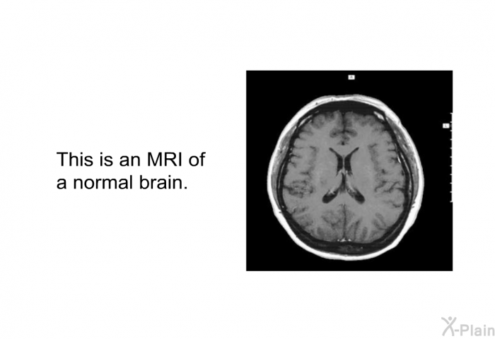 This is an MRI of a normal brain.