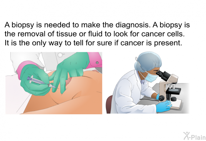 A biopsy is needed to make the diagnosis. A biopsy is the removal of tissue or fluid to look for cancer cells. It is the only way to tell for sure if cancer is present.
