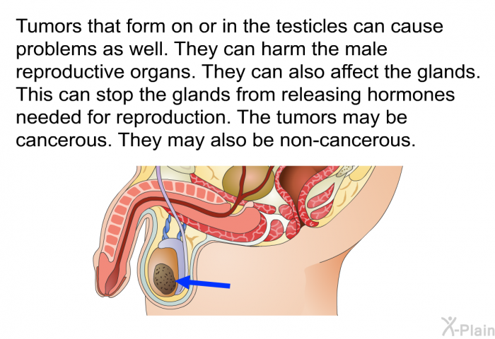 Tumors that form on or in the testicles can cause problems as well. They can harm the male reproductive organs. They can also affect the glands. This can stop the glands from releasing hormones needed for reproduction. The tumors may be cancerous. They may also be non-cancerous.