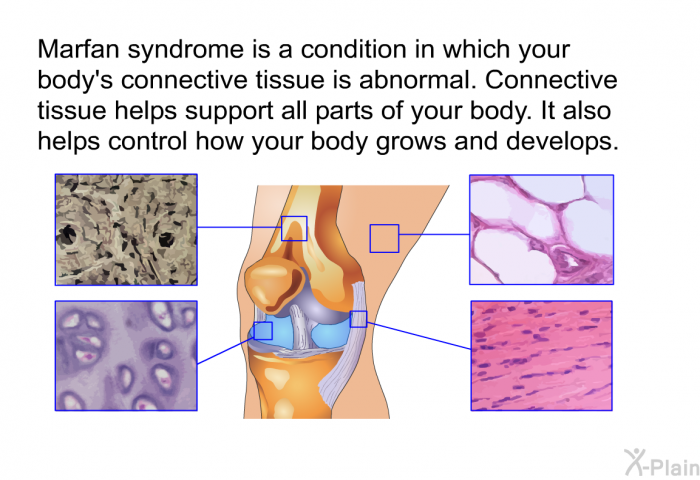 Marfan syndrome is a condition in which your body's connective tissue is abnormal. Connective tissue helps support all parts of your body. It also helps control how your body grows and develops.
