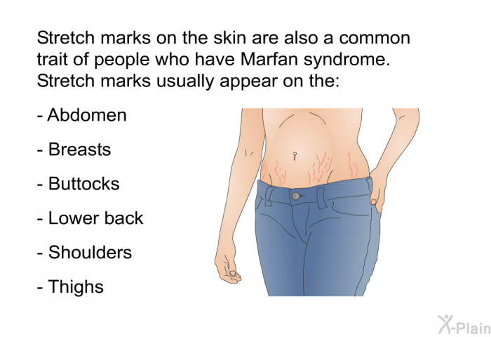 Stretch marks on the skin are also a common trait of people who have Marfan syndrome. Stretch marks usually appear on the:  Abdomen Breasts Buttocks Lower back Shoulders Thighs