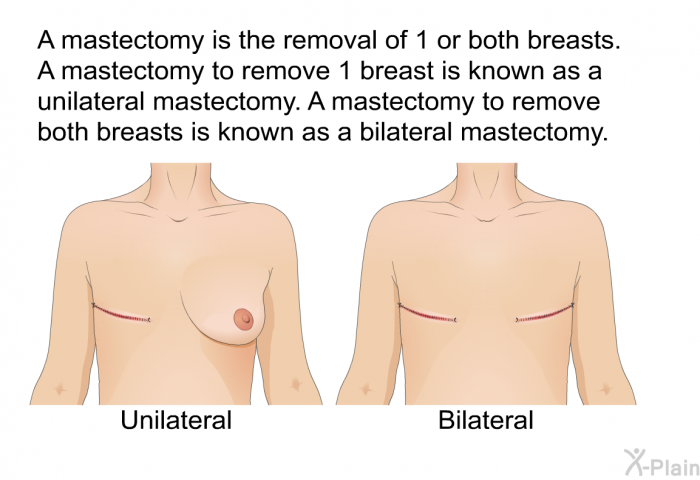 A mastectomy is the removal of 1 or both breasts. A mastectomy to remove 1 breast is known as a unilateral mastectomy. A mastectomy to remove both breasts is known as a bilateral mastectomy.