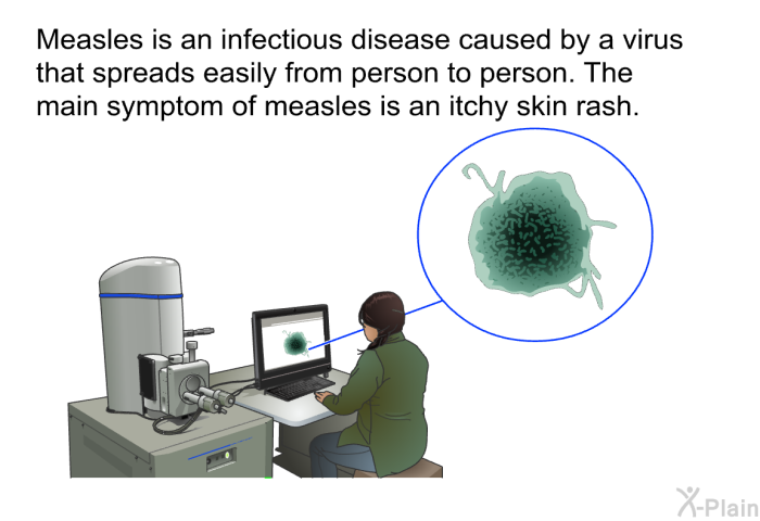 Measles is an infectious disease caused by a virus that spreads easily from person to person. The main symptom of measles is an itchy skin rash.