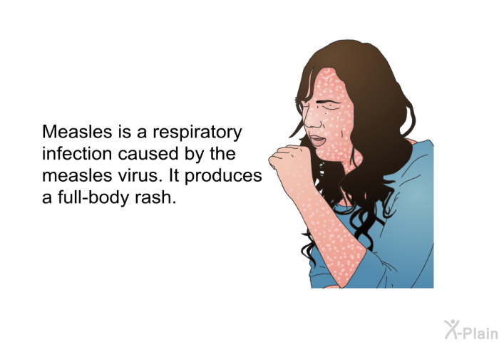 Measles is a respiratory infection caused by the measles virus. It produces a full-body rash.
