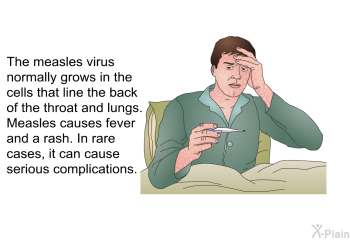 The measles virus normally grows in the cells that line the back of the throat and lungs. Measles causes fever and a rash. In rare cases, it can cause serious complications.