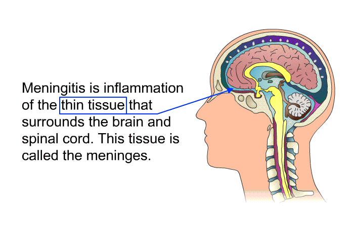 Meningitis is inflammation of the thin tissue that surrounds the brain and spinal cord. This tissue is called the meninges.