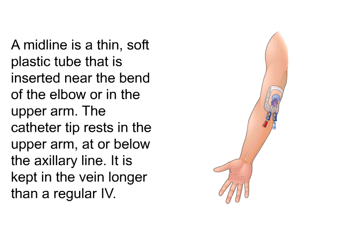 A midline is a thin, soft plastic tube that is inserted near the bend of the elbow or in the upper arm. The catheter tip rests in the upper arm, at or below the axillary line. It is kept in the vein longer than a regular IV.