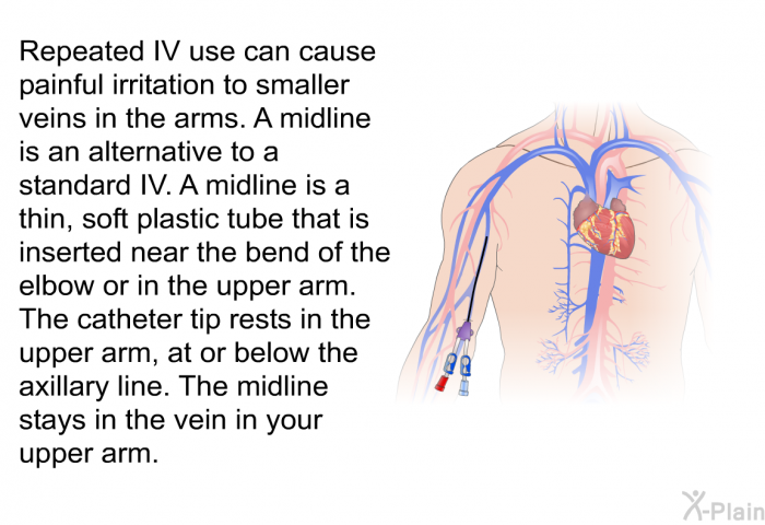Repeated IV use can cause painful irritation to smaller veins in the arms. A midline is an alternative to a standard IV. A midline is a thin, soft plastic tube that is inserted near the bend of the elbow or in the upper arm. The catheter tip rests in the upper arm, at or below the axillary line. The midline stays in the vein in your upper arm.
