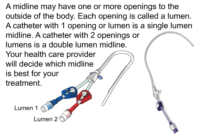 A midline may have one or more openings to the outside of the body. Each opening is called a lumen. A catheter with 1 opening or lumen is a single lumen midline. A catheter with 2 openings or lumens is a double lumen midline. Your health care provider will decide which midline is best for your treatment.