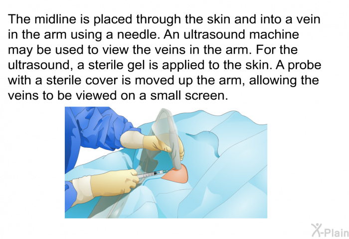 The midline is placed through the skin and into a vein in the arm using a needle. An ultrasound machine may be used to view the veins in the arm. For the ultrasound, a sterile gel is applied to the skin. A probe with a sterile cover is moved up the arm, allowing the veins to be viewed on a small screen.