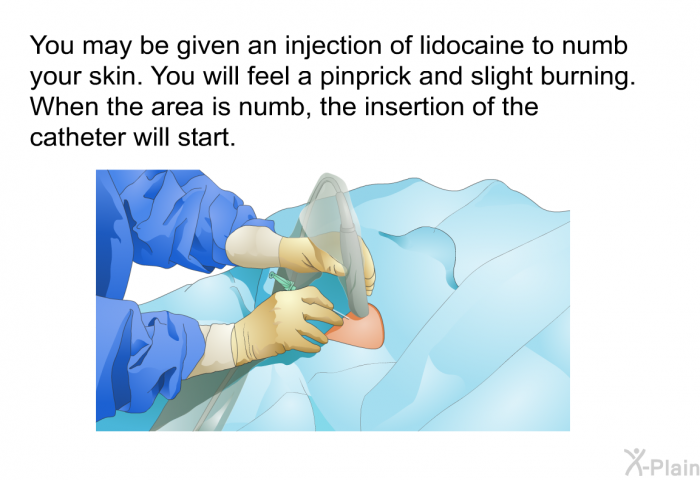 You may be given an injection of lidocaine to numb your skin. You will feel a pinprick and slight burning. When the area is numb, the insertion of the catheter will start.