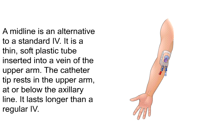 A midline is an alternative to a standard IV. It is a thin, soft plastic tube inserted into a vein of the upper arm. The catheter tip rests in the upper arm, at or below the axillary line. It lasts longer than a regular IV.