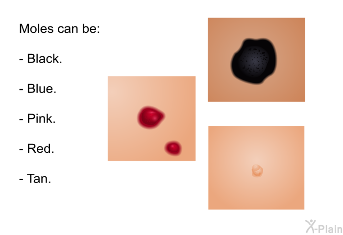 Moles can be:  Black. Blue. Pink. Red. Tan.