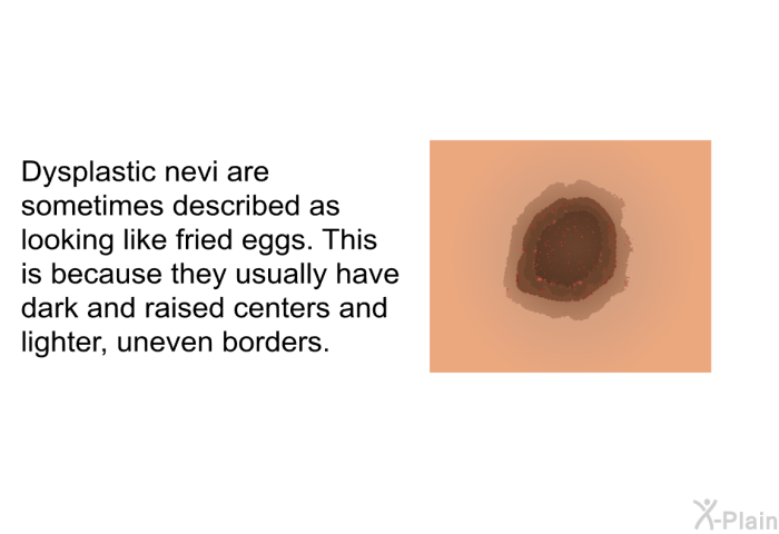 Dysplastic nevi are sometimes described as looking like fried eggs. This is because they usually have dark and raised centers and lighter, uneven borders.