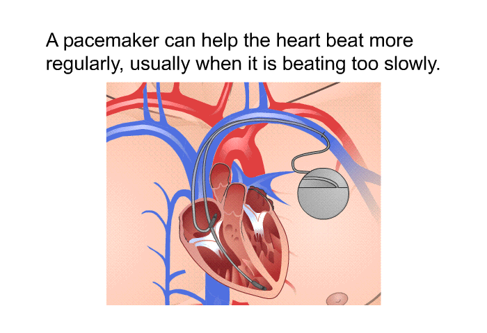 A pacemaker can help the heart beat more regularly, usually when it is beating too slowly.