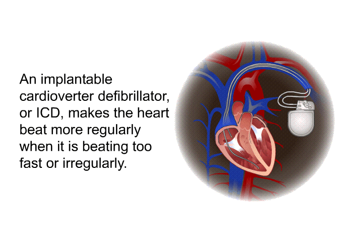 An implantable cardioverter defibrillator, or ICD, makes the heart beat more regularly when it is beating too fast or irregularly.