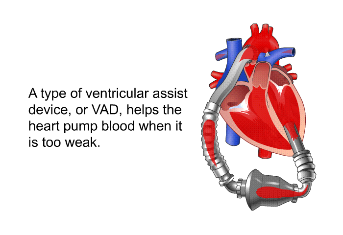 A type of ventricular assist device, or VAD, helps the heart pump blood when it is too weak.