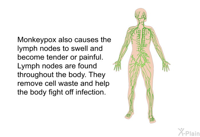 Monkeypox also causes the lymph nodes to swell and become tender or painful. Lymph nodes are found throughout the body. They remove cell waste and help the body fight off infection.