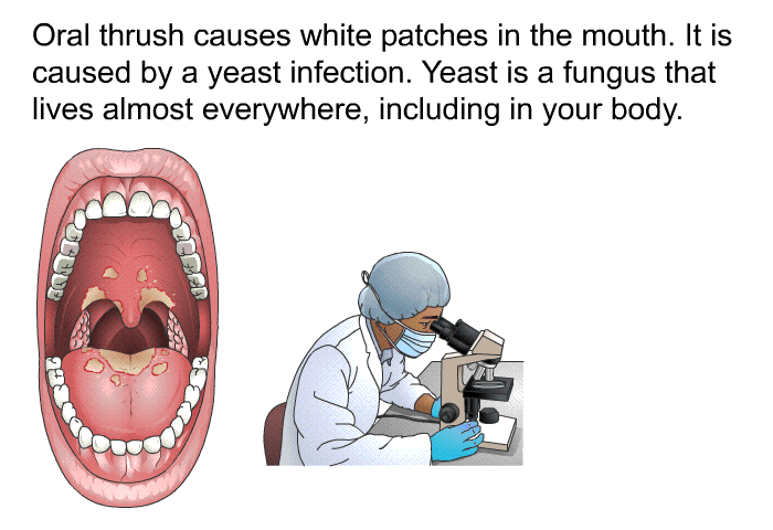 Oral thrush causes white patches in the mouth. It is caused by a yeast infection. Yeast is a fungus that lives almost everywhere, including in your body.