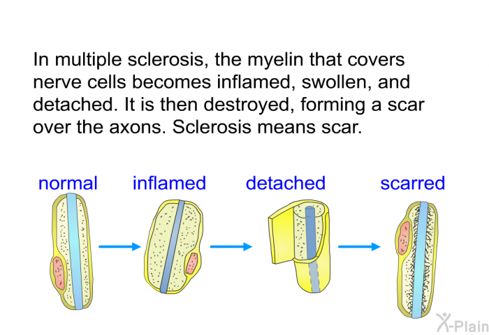 In multiple sclerosis, the myelin that covers nerve cells becomes inflamed, swollen, and detached. It is then destroyed, forming a scar over the axons. Sclerosis means scar.