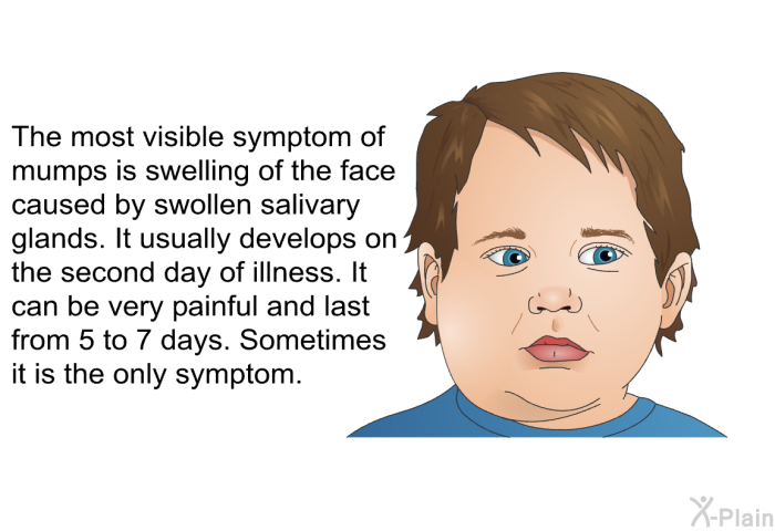 The most visible symptom of mumps is swelling of the face caused by swollen salivary glands. It usually develops on the second day of illness. It can be very painful and last from 5 to 7 days. Sometimes it is the only symptom.