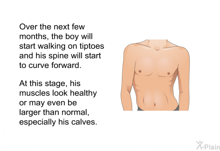 Over the next few months, the boy will start walking on tiptoes and his spine will start to curve forward. At this stage, his muscles look healthy or may even be larger than normal, especially his calves.