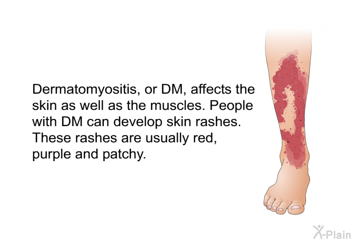 Dermatomyositis, or DM, affects the skin as well as the muscles. People with DM can develop skin rashes. These rashes are usually red, purple and patchy.