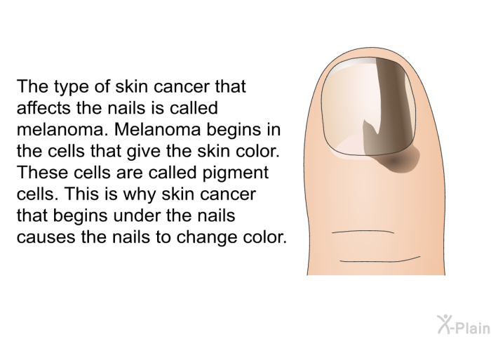 The type of skin cancer that affects the nails is called melanoma. Melanoma begins in the cells that give the skin color. These cells are called pigment cells. This is why skin cancer that begins under the nails causes the nails to change color.