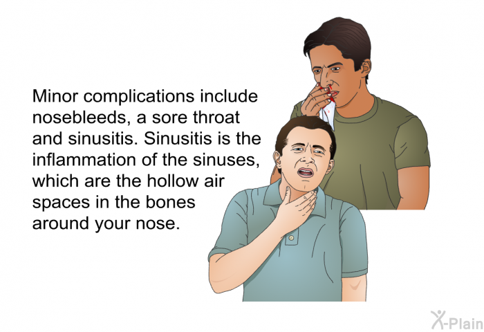 Minor complications include nosebleeds, a sore throat and sinusitis. Sinusitis is the inflammation of the sinuses, which are the hollow air spaces in the bones around your nose.